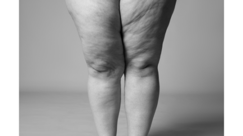 Van obesitas tot cellulite: 8 op de 10 lipoedeempatiënten verkeerd behandeld